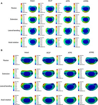 Biomechanical study of anterior transpedicular root screw intervertebral fusion system of lower cervical spine: a finite element analysis